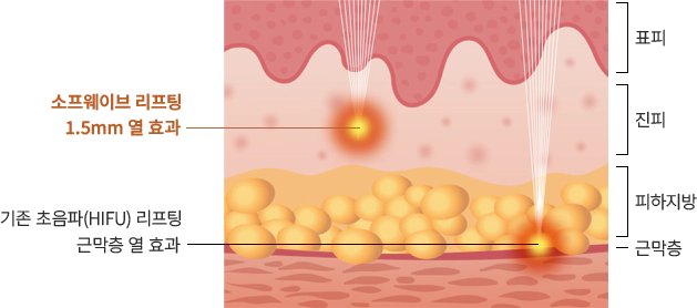 sofwave 슬라이드 1번째
