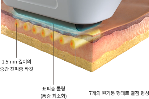 sofwave 슬라이드 2번째