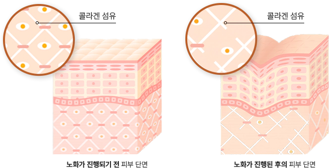 thermage 슬라이드 1번째