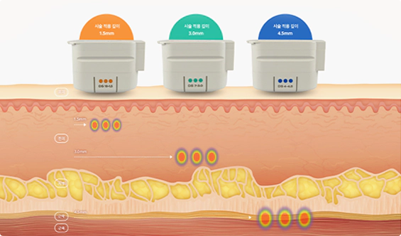 ultherapy 슬라이드 2번째